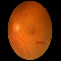 diabetic retinopathy